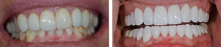 20 CEREC Crowns Were Placed in One Visit