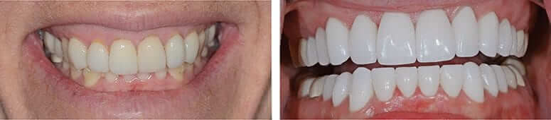 10 Upper and 10 Lower CEREC Crowns 10 Upper and 10 Lower CEREC Crowns