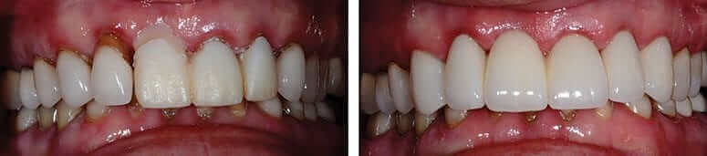 3 Unit Dental Bridge with 3 CEREC Crowns