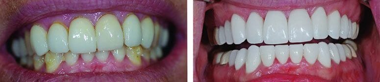 CEREC Crowns Before and After Photo