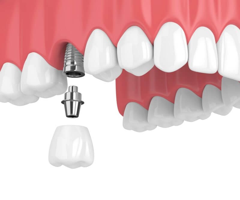 and dental implant