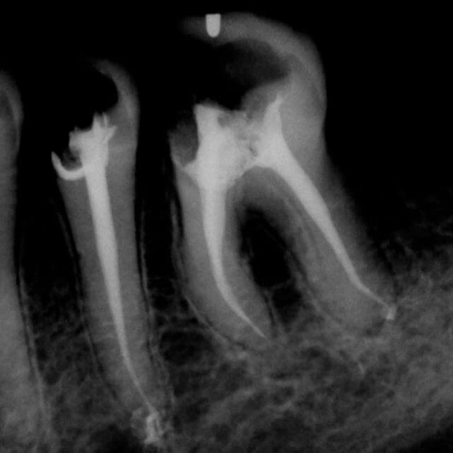 after root canal is completed on two teeth as seen in digital x ray