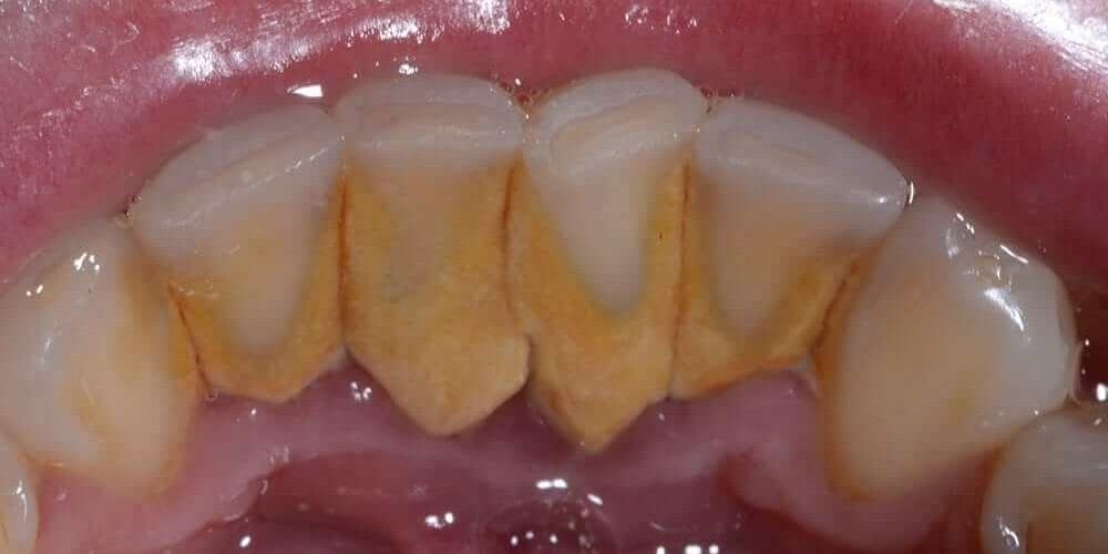Peridontal Disease Treatment and Deep Teeth Cleaning Required for Hard Plaque Build Up