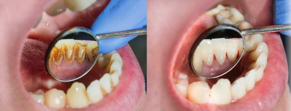 Before and After Plaque and Tartar Removal. before and after periodontal disease plaque tartar removal