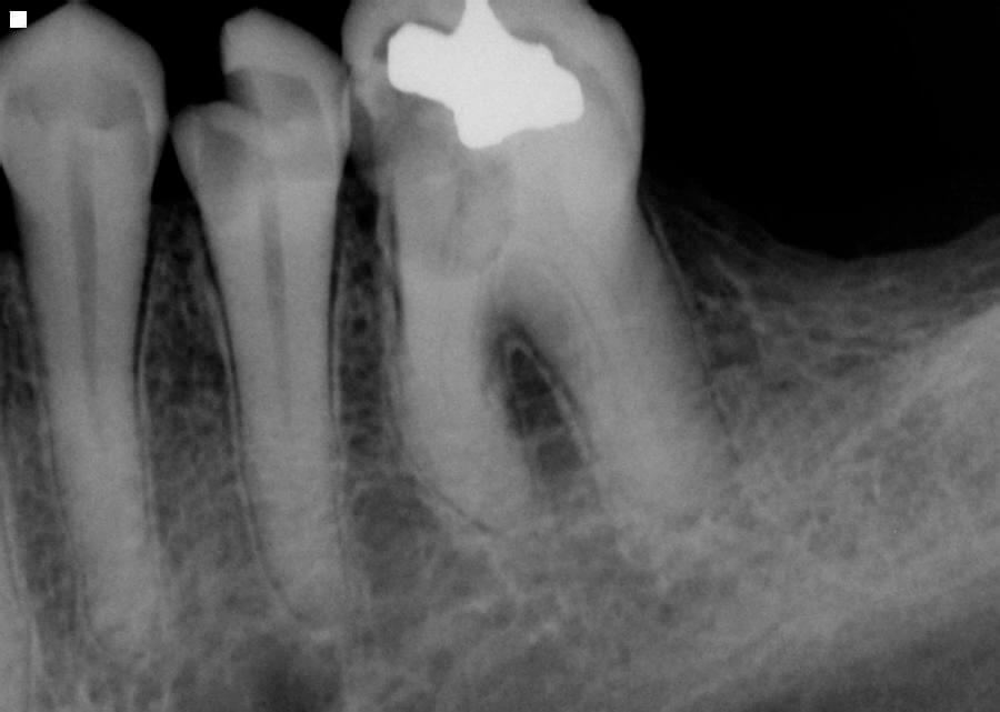 before root canal on left mandibular with digital x ray