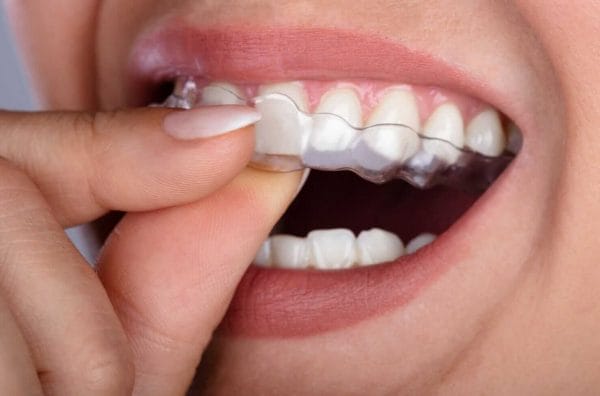 bruxism mouth guard
