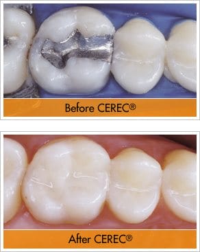 CEREC Before and After Crowns with our smile makeover dentist