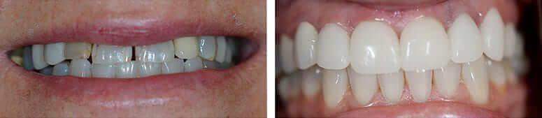 CEREC Crowns and Teeth Whitening