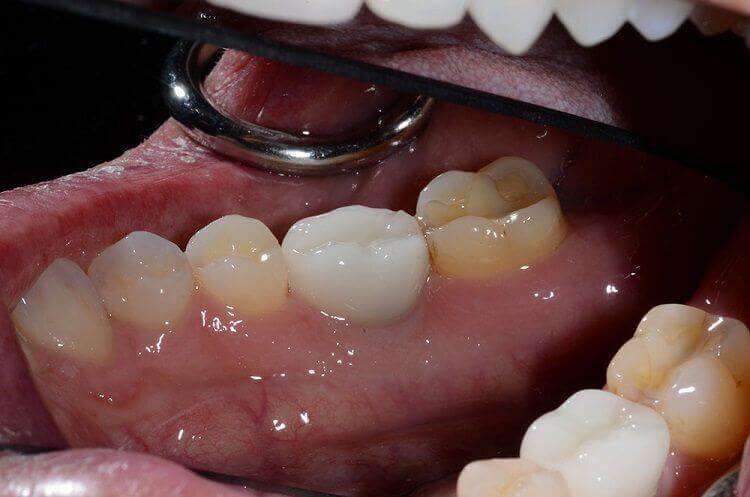 Two Crowns Over Dental Implants