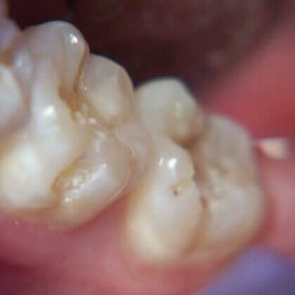 Patient with Decay and Cavities that Waited a Long Time Before Coming in to see The Dentist. decay and cavities