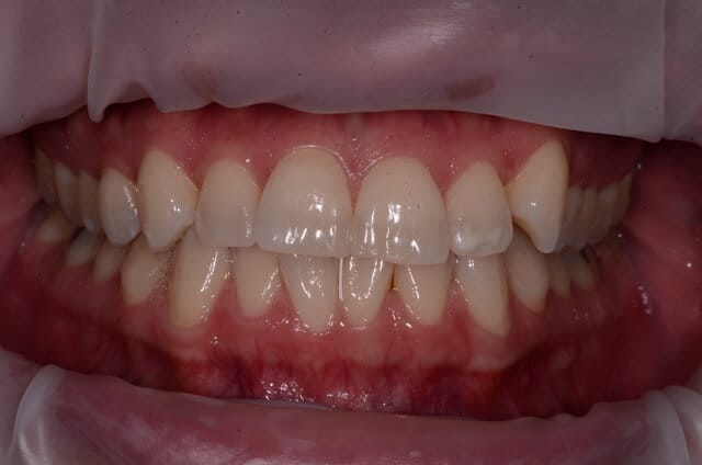 Dentinogenesis Imperfecta (DI) Dentinogenesis Imperfecta (DI)