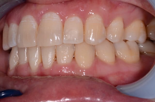 Dental Enamel Hypoplasia - Patient Image Copyright by Lakefront Family Dentistry