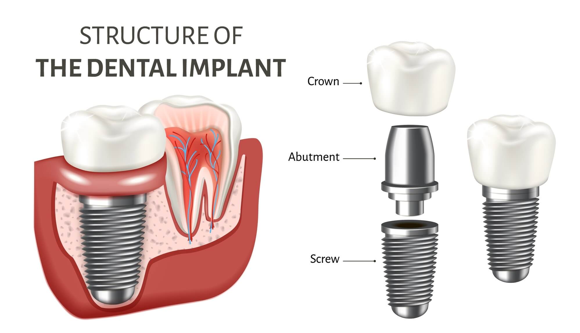 dental implant prices