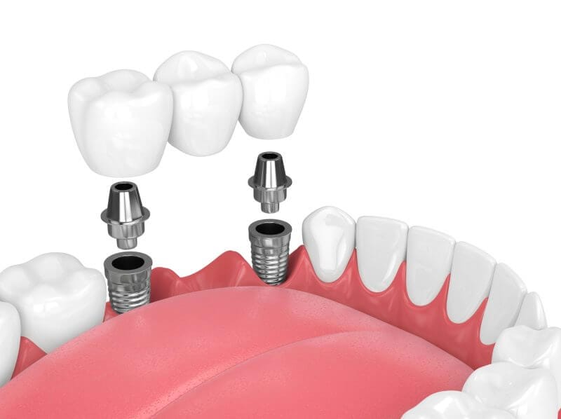 dental implant cost