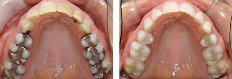 Replaced Amalgam and Decay with CEREC CRowns