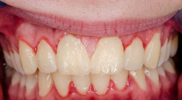 Gingivitis Hyperplasia