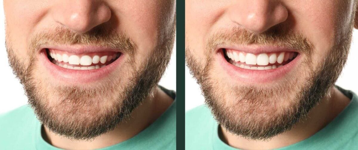gummy smile botox