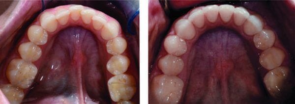Before and After Invisalign Treatment at Lakefront Family Dentistry