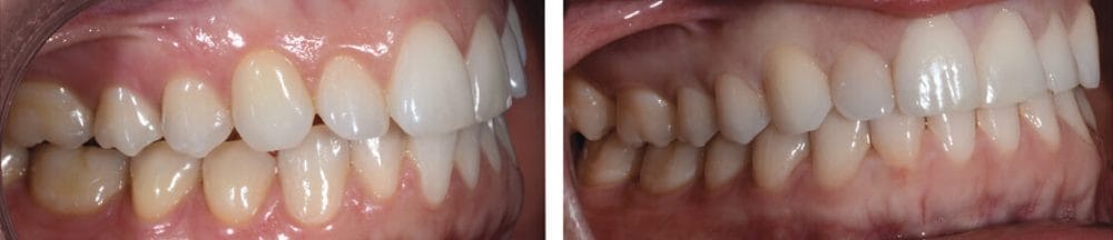 invisalign before and after side teeth crooked and spaced far apart