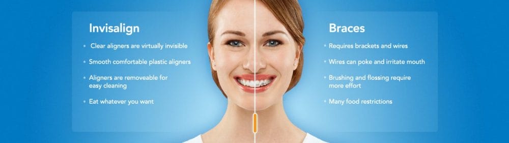 invisalign versus metal braces