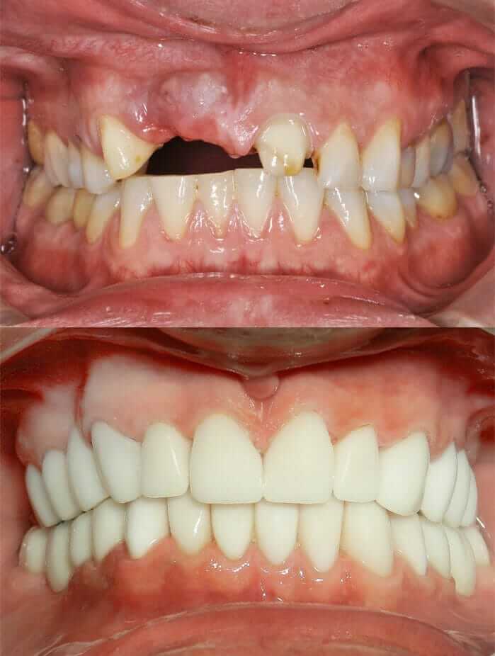 periodontal disease treatment and CEREC crowns