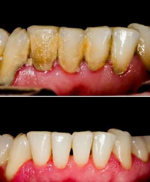 Periodontal Disease Treatment Patient at Lakefront Family Dentistry (Before and After)