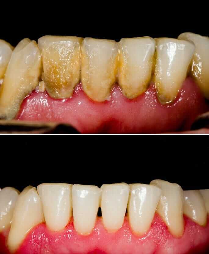 periodontal disease symptoms and treatment dentist. ANUG is a serious dental condition and needs treatment immediately.