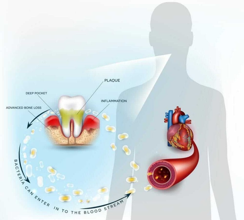 Plaque and Bacteria Enter the Bloodstream from Gum Disease and Periodontitis, Possibly Causing a Heart Attack or Stroke. Make Sure and Get Your Professional, Biannual Teeth Cleaning. Plaque and Bacteria Enter the Bloodstream from Gum Disease and Periodontitis, Possibly Causing a Heart Attack or Stroke. Make Sure and Get Your Professional, Biannual Teeth Cleaning.