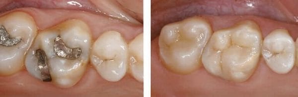 replace amalgam fillings with composite resin replace amalgam fillings with composite resin