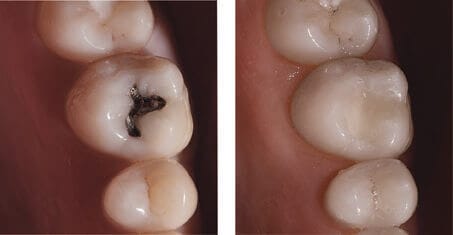 Replaced Silver Filling with White Filling Replaced Amalgam (Silver) with White Filling to Match Surrounding Teeth Color