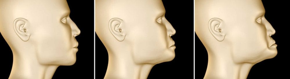 Bone Loss Resorption Progression without Early Dental Treatment Bone Loss Resorption Progression without Early Dental Treatment