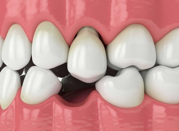 Shifting Teeth, Decreased Biting and Chewing Efficiency, Jawbone Loss, Adjacent Tooth Damage and Increased Risk of Gum Disease Can Occur When a Tooth is Extracted without a Replacement Dental Implant and Crown in That Position. Shifting Teeth, Decreased Biting and Chewing Efficiency, Jawbone Loss, Adjacent Tooth Damage and Increased Risk of Gum Disease Can Occur When a Tooth is Extracted without a Replacement Dental Implant and Crown in That Position.