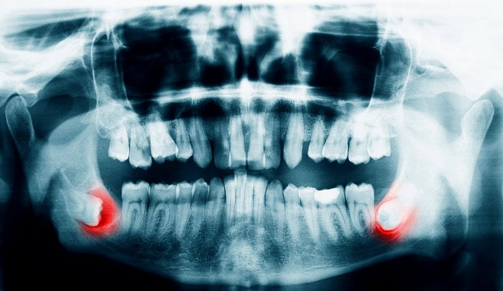 Dentist xrays and safety with radiation