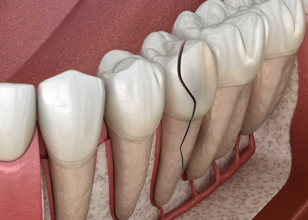Split Tooth