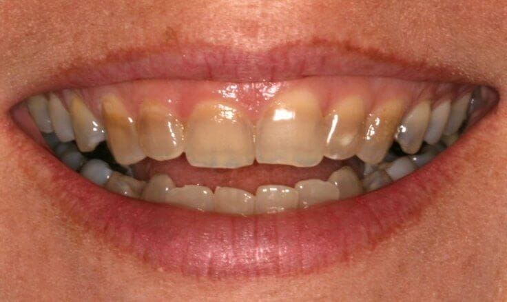 Tetracycline Stains Can be Corrected with CEREC Veneers
