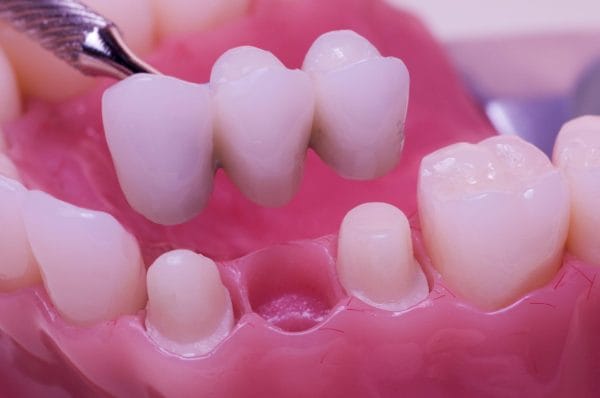 Three Unit Dental Bridge Example