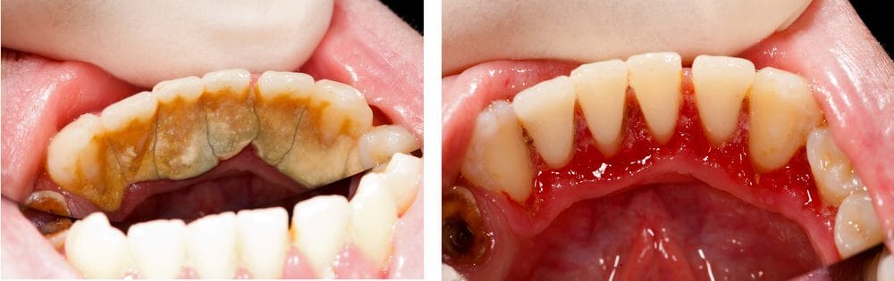 Gum Disease Treatment Before and After Picture