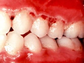 Trench Mouth