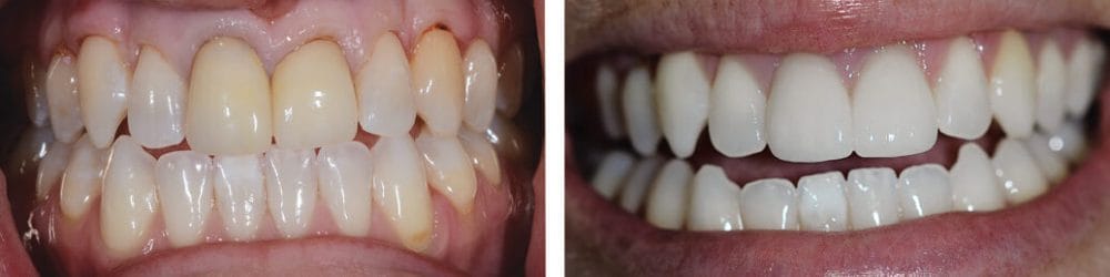 Two Front Teeth Veneers and Teeth Whitening to Remove Yellow Staining