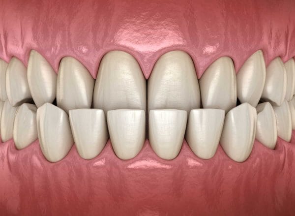 Contact Us for Underbite Correction with Invisalign Contact Us for Underbite Correction with Invisalign