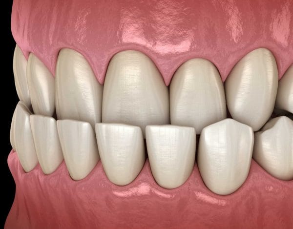 underbite underbite