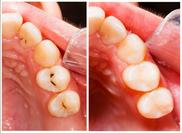 white tooth filling