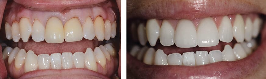 Yellowing Teeth Have a Great, New Healthy Look with Teeth Whitening and Two Front Teeth Veneers Yellowing Teeth Have a Great, New Healthy Look with Teeth Whitening and Two Front Teeth Veneers